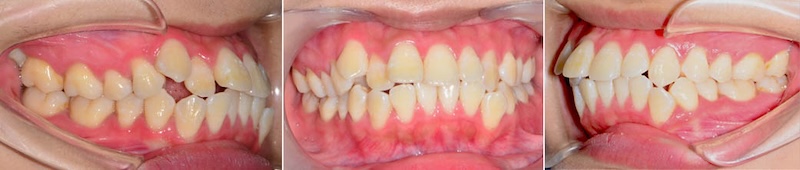 台中患者在暴牙矯正前各角度的牙齒咬合近照,有骨暴、牙齒亂、牙齒擁擠等問題