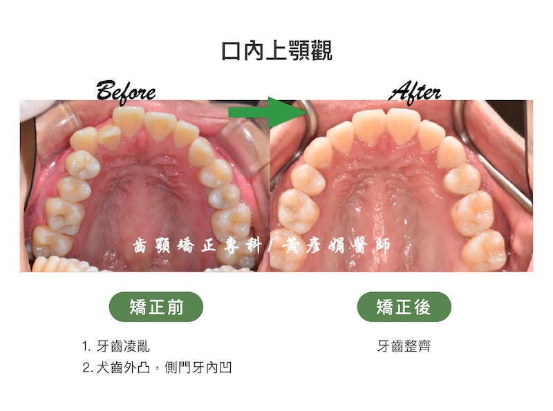 台中患者暴牙矯正前後的口內上顎觀比較:矯正前牙齒擁擠凌亂,且右側犬齒外凸、側門牙內凹;矯正後牙齒整齊