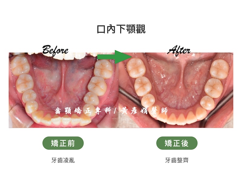 台中患者暴牙矯正前後的口內下顎觀比較:矯正前牙齒亂;矯正後牙齒整齊
