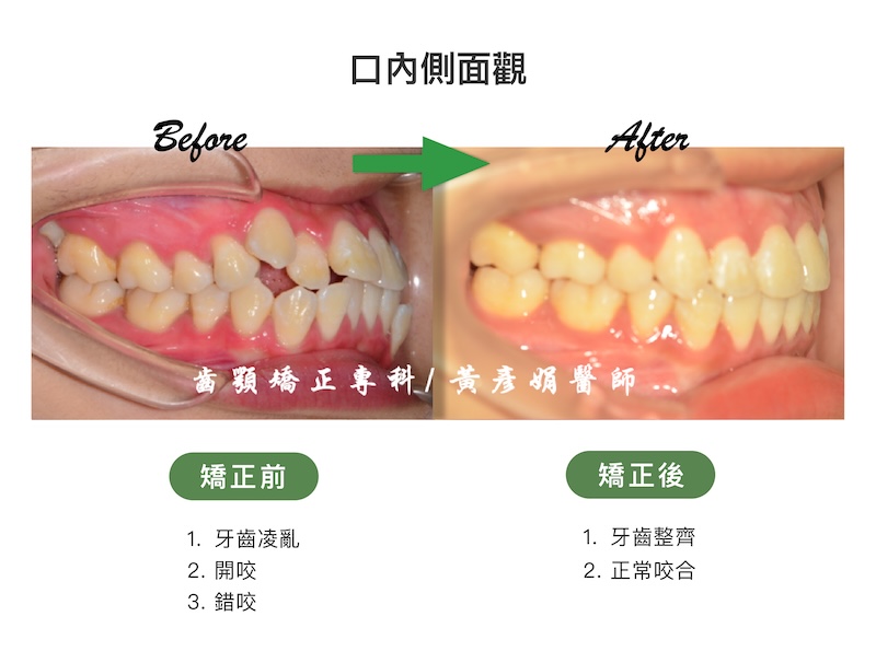 台中患者暴牙矯正前後的口內側面觀比較:矯正前牙齒亂,並伴隨開咬、錯咬;矯正後牙齒整齊,恢復正常咬合