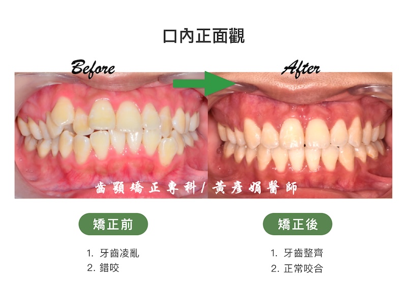 台中患者暴牙矯正前後的口內正面觀比較:矯正前牙齒凌亂、錯咬;矯正後牙齒整齊,恢復正常咬合