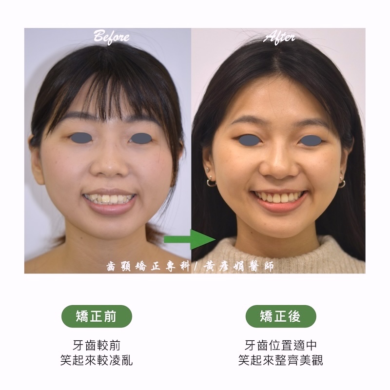 台中患者暴牙矯正前後的正面笑容比較:矯正前牙齒前凸,笑起來較凌亂;矯正後牙齒位置適中,笑起來整齊美觀