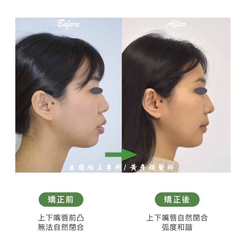 台中患者暴牙矯正前後的側面臉型外觀比較:矯正前上下嘴唇前凸,無法自然閉合;矯正後上下嘴唇自然閉合,弧度和諧