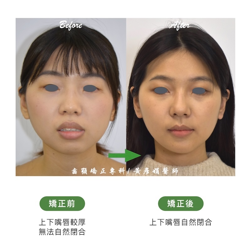 台中患者暴牙矯正前後的正面臉型外觀比較:矯正前上下嘴唇較厚,無法自然閉合;矯正後嘴唇自然閉合