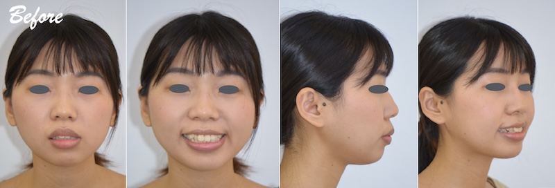 台中患者在暴牙矯正前的各角度的臉型外觀,因骨暴導致嘴唇閉不起來,伴隨牙齒亂、牙齒擁擠,虎牙不對稱等問題